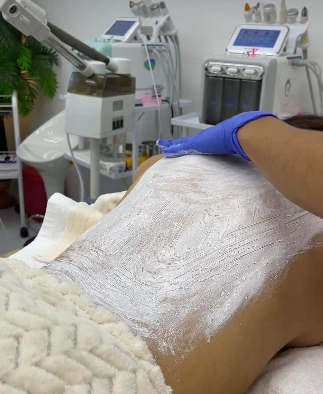 Limpieza Profunda de Espalda (Acné)